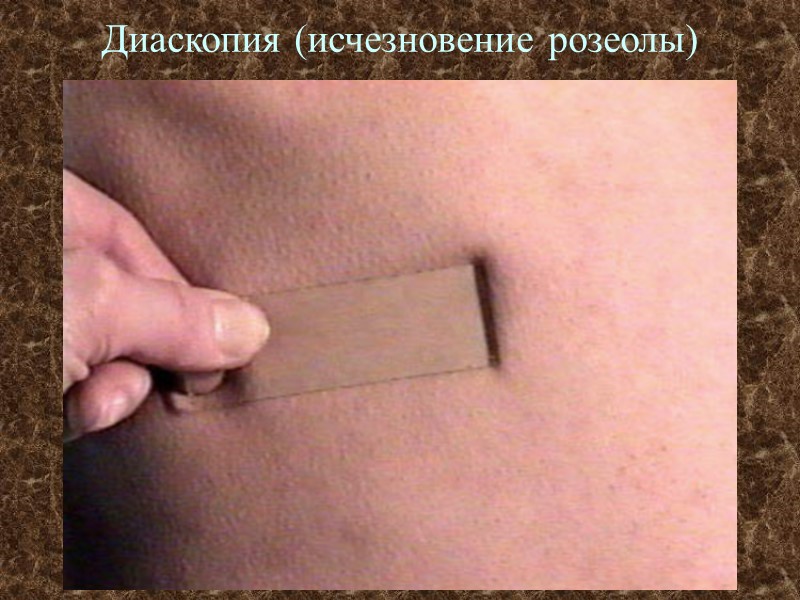 Диаскопия (исчезновение розеолы)